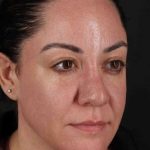 Browlift Before & After Patient #1363