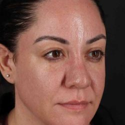 Browlift Before & After Patient #1363