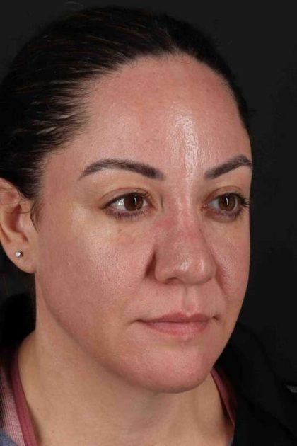 Browlift Before & After Patient #1363