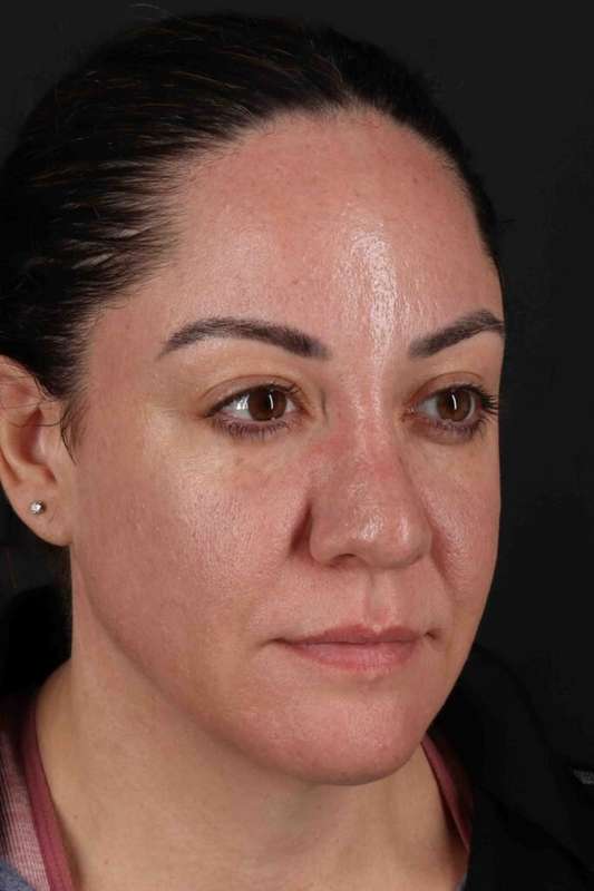 Browlift Before & After Patient #1363