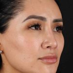 Rhinoplasty Before & After Patient #2895