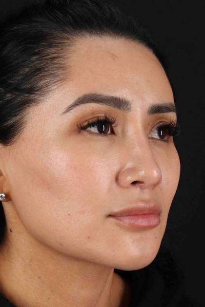 Rhinoplasty Before & After Patient #2895