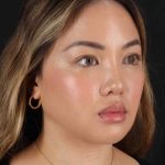 Rhinoplasty Before & After Patient #2906