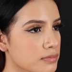 Rhinoplasty Before & After Patient #2917