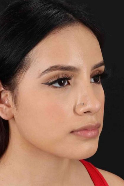 Rhinoplasty Before & After Patient #2917