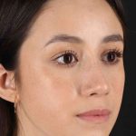 Rhinoplasty Before & After Patient #2928