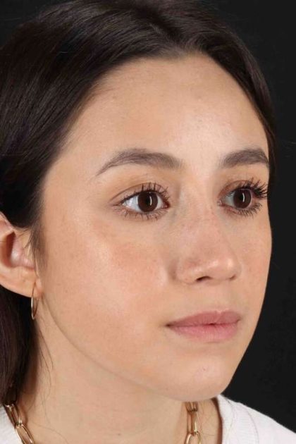 Rhinoplasty Before & After Patient #2928