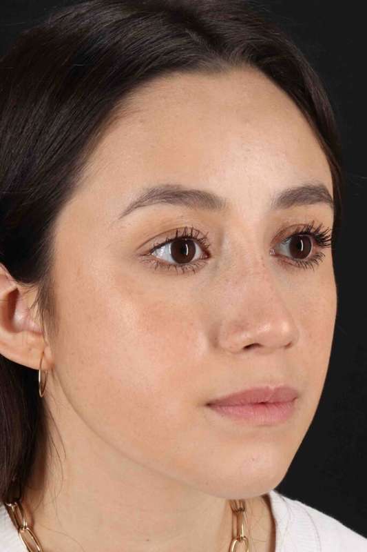 Rhinoplasty Before & After Patient #2928