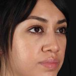 Rhinoplasty Before & After Patient #2939