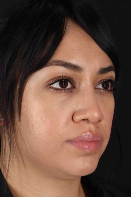 Rhinoplasty Before & After Patient #2939