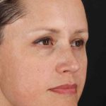 Rhinoplasty Before & After Patient #2950
