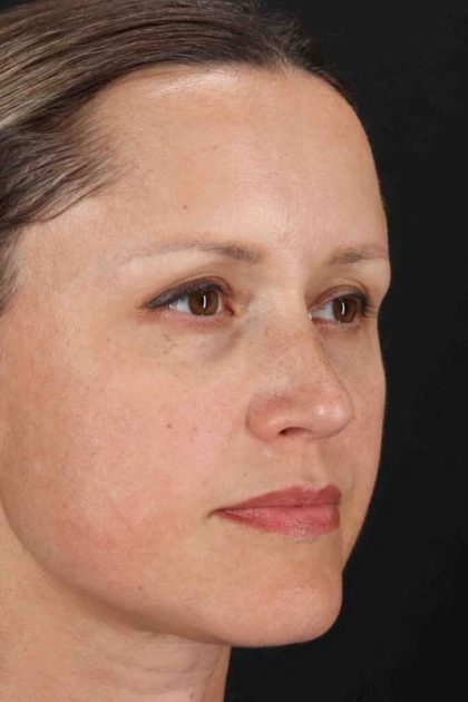 Rhinoplasty Before & After Patient #2950