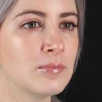 Rhinoplasty Before & After Patient #2961