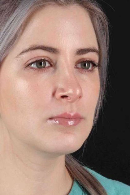Rhinoplasty Before & After Patient #2961