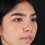 Rhinoplasty Before & After Patient #2972