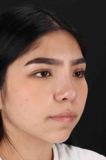 Rhinoplasty Before & After Patient #2972