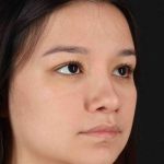 Rhinoplasty Before & After Patient #2983