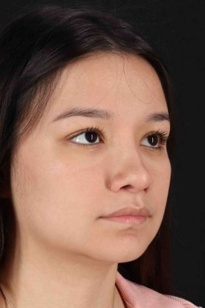 Rhinoplasty Before & After Patient #2983
