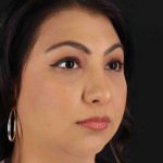 Rhinoplasty Before & After Patient #2994