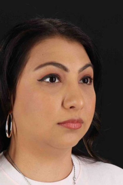 Rhinoplasty Before & After Patient #2994