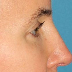 Browlift Before & After Patient #1373