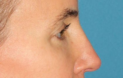 Browlift Before & After Patient #1373