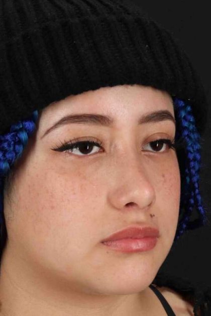Rhinoplasty Before & After Patient #3016