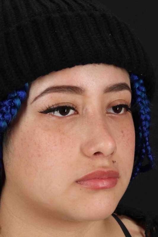 Rhinoplasty Before & After Patient #3016