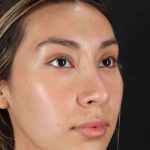 Rhinoplasty Before & After Patient #3027