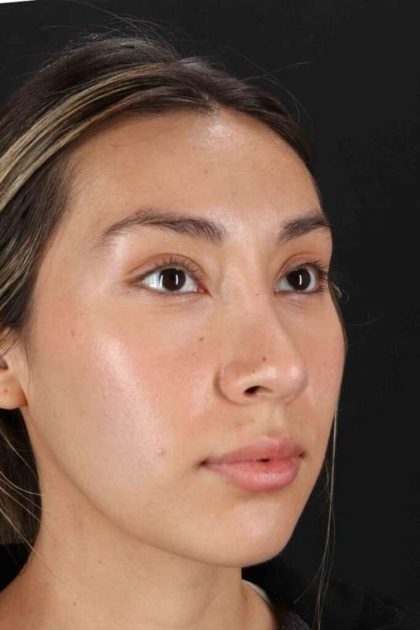 Rhinoplasty Before & After Patient #3027