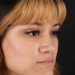 Rhinoplasty Before & After Patient #3038