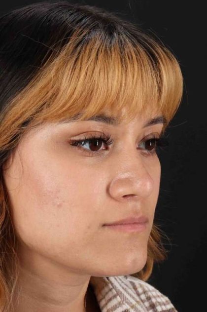 Rhinoplasty Before & After Patient #3038