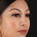 Rhinoplasty Before & After Patient #3049