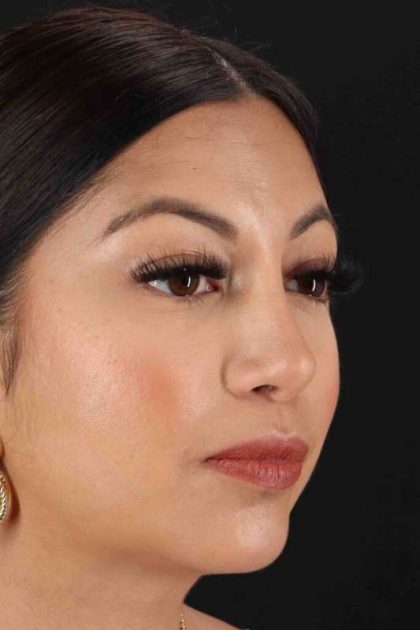 Rhinoplasty Before & After Patient #3049