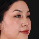 Rhinoplasty Before & After Patient #3060
