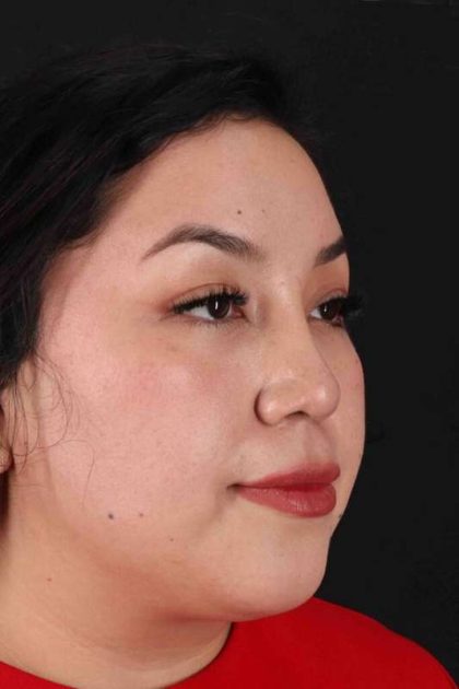 Rhinoplasty Before & After Patient #3060