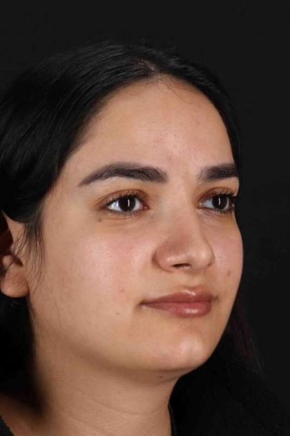 Rhinoplasty Before & After Patient #3071