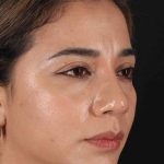 Rhinoplasty Before & After Patient #3082