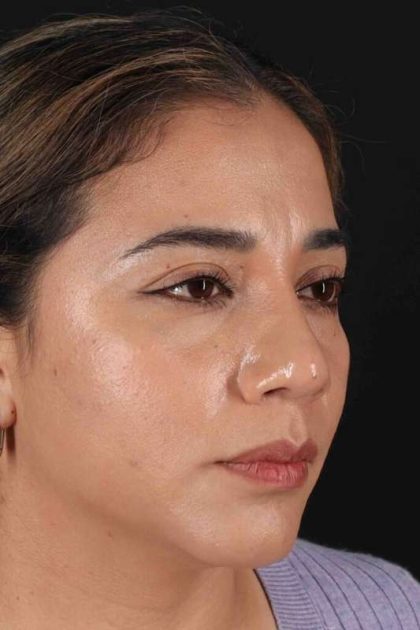 Rhinoplasty Before & After Patient #3082