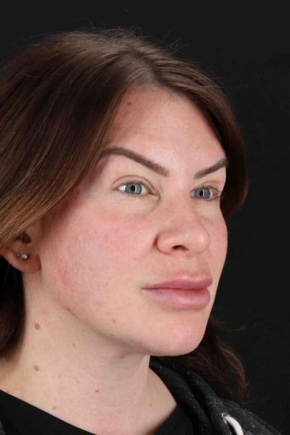 Rhinoplasty Before & After Patient #3093
