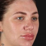 Rhinoplasty Before & After Patient #3104