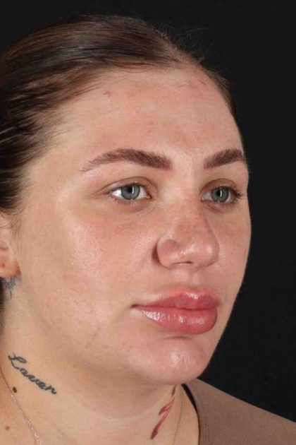 Rhinoplasty Before & After Patient #3104