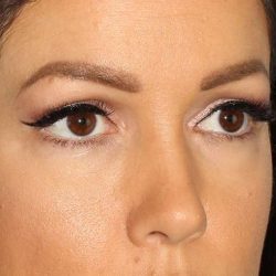 Browlift Before & After Patient #1384