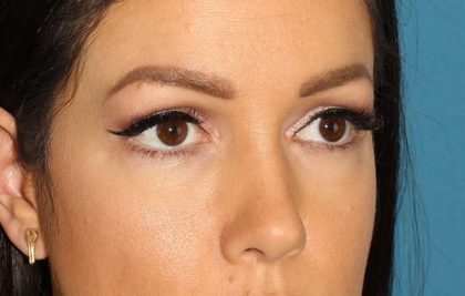 Browlift Before & After Patient #1384