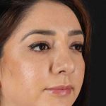Rhinoplasty Before & After Patient #3115