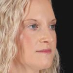 Rhinoplasty Before & After Patient #3126