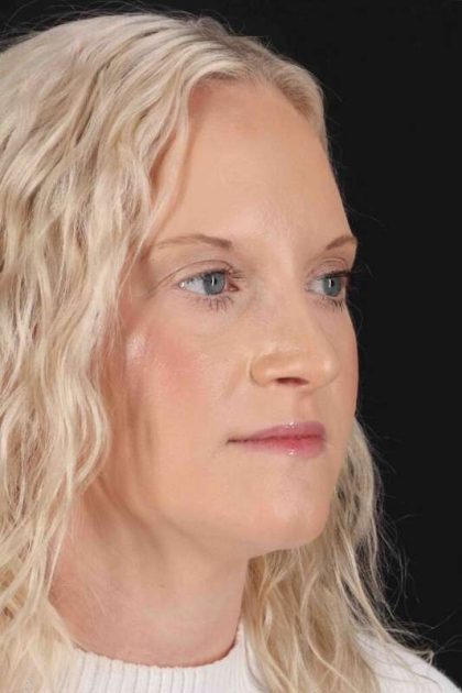 Rhinoplasty Before & After Patient #3126