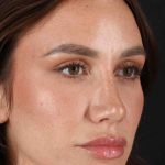 Rhinoplasty Before & After Patient #3137
