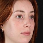 Rhinoplasty Before & After Patient #3170