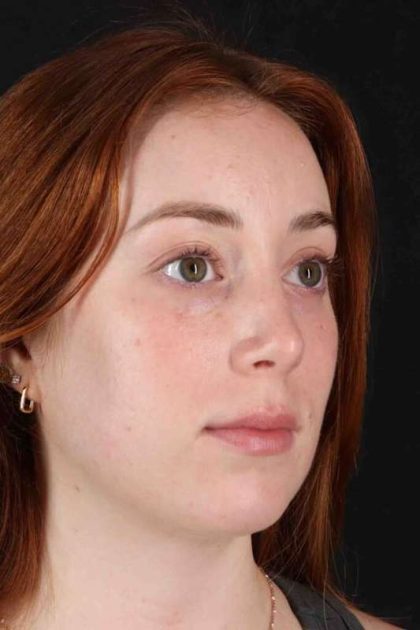 Rhinoplasty Before & After Patient #3170